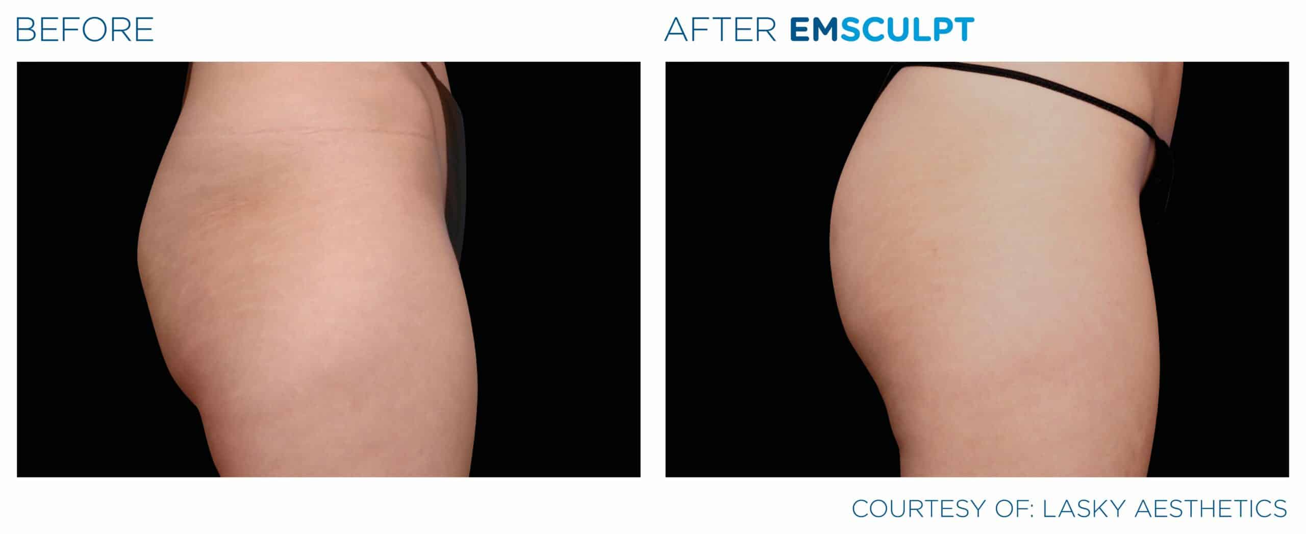 EMSculpt Oakville, EMSculpt Near Me