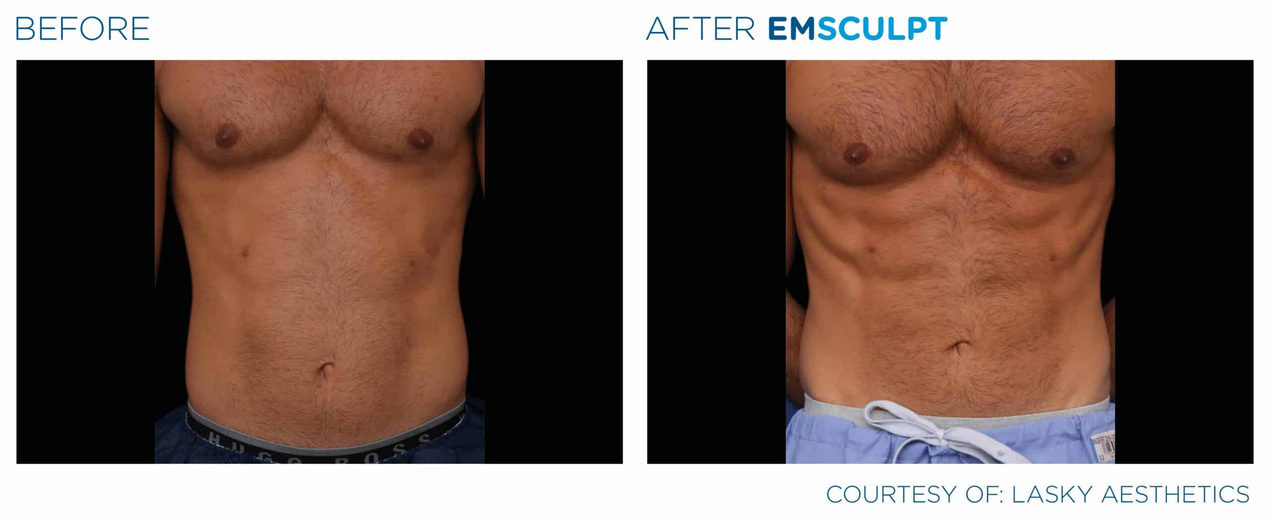 EMSCULPT Body Toning, Sculpting