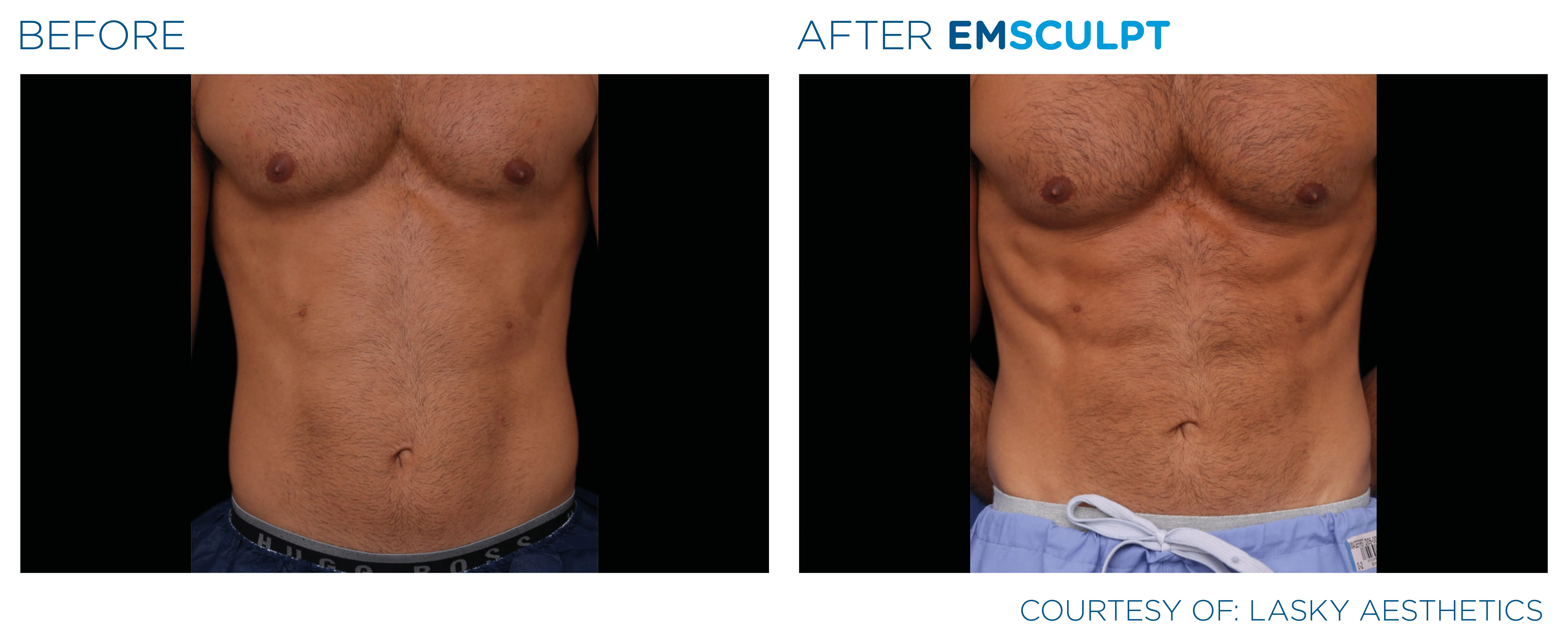 I tried Emsculpt, and here's what happened (Part 1