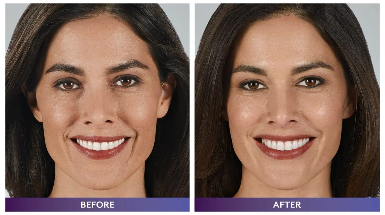 Juvéderm filler for Cheeks, Smokers Lines, Lips, & Nasolabial Folds