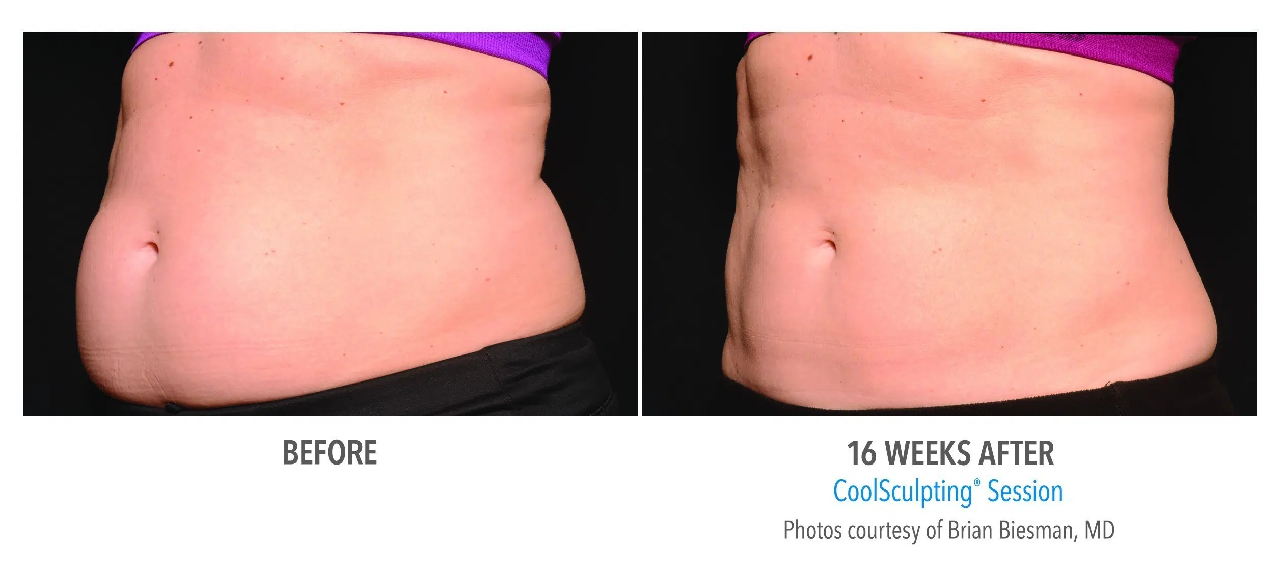 CoolSculpting London Ontario