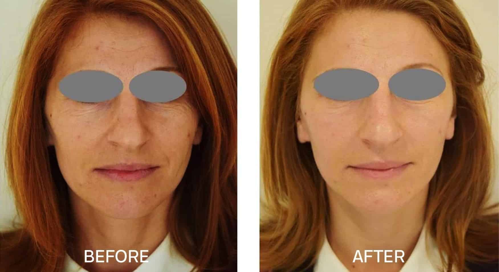 Fotona 4D Toronto Fotona 4D Near Me Fotana Laser Before & After Fontona 4D Cost Fotona 4D Toronto Fotona 4D Near Me Fotana Laser Before & After Fontona 4D Cost