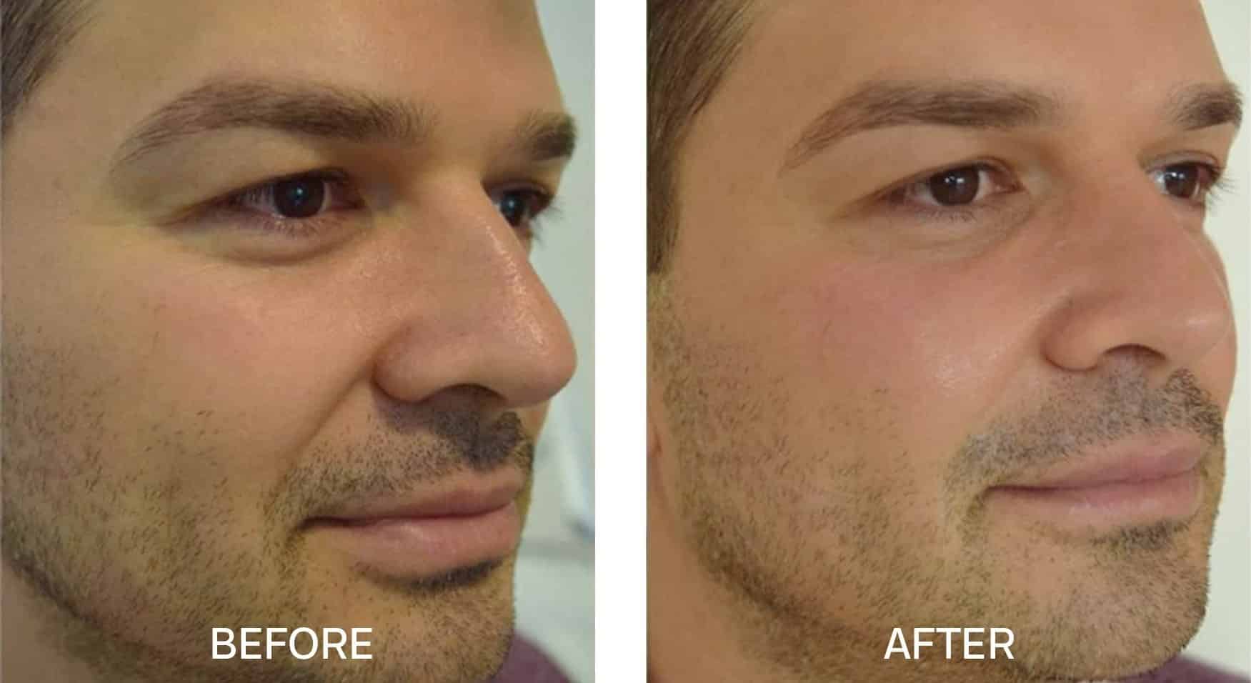 Fotona 4d Toronto Fotona Skin Tightening Near Me Fotana Laser Treatment Fotona 4d Toronto Fotona Skin Tightening Near Me Fotana Laser Treatment