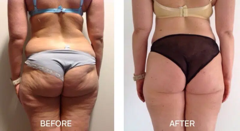 buttock cellulite