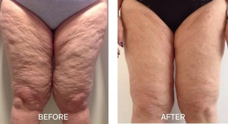 thigh cellulite
