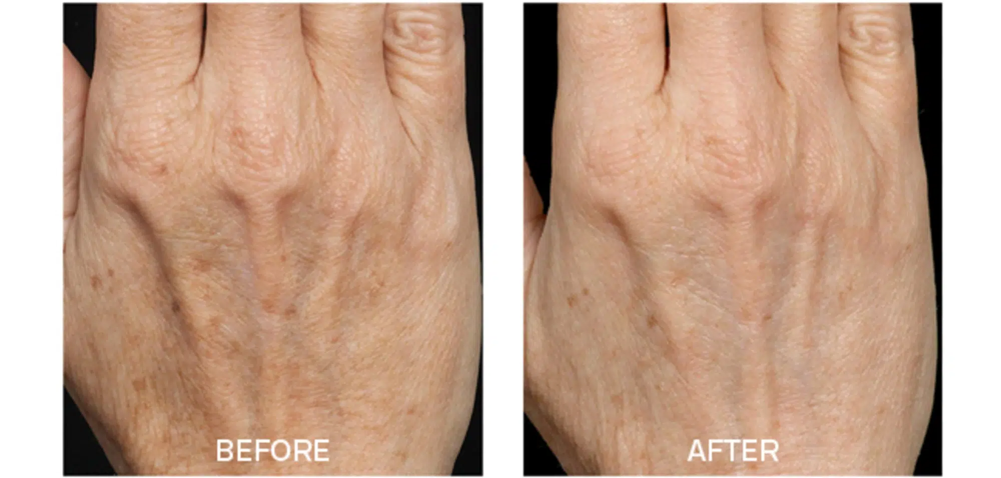 Fraxel for Aging Hands