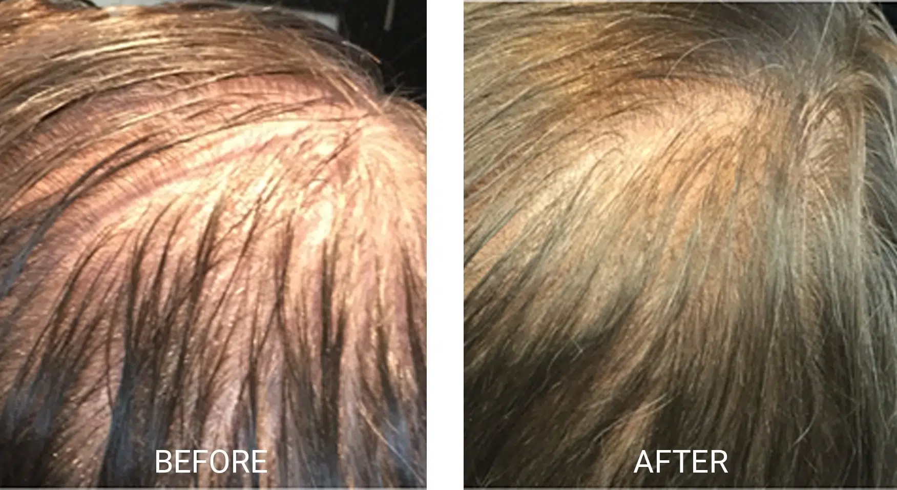 PRP Hair Treatment St. Catharines PRP Hair Restoration St Catharines Ontario