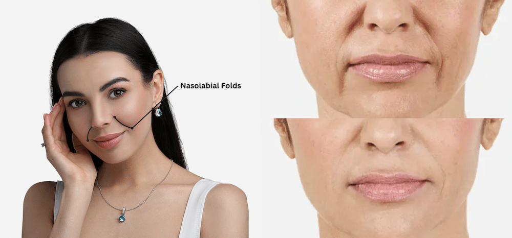Nasolabial Fold Filler Results