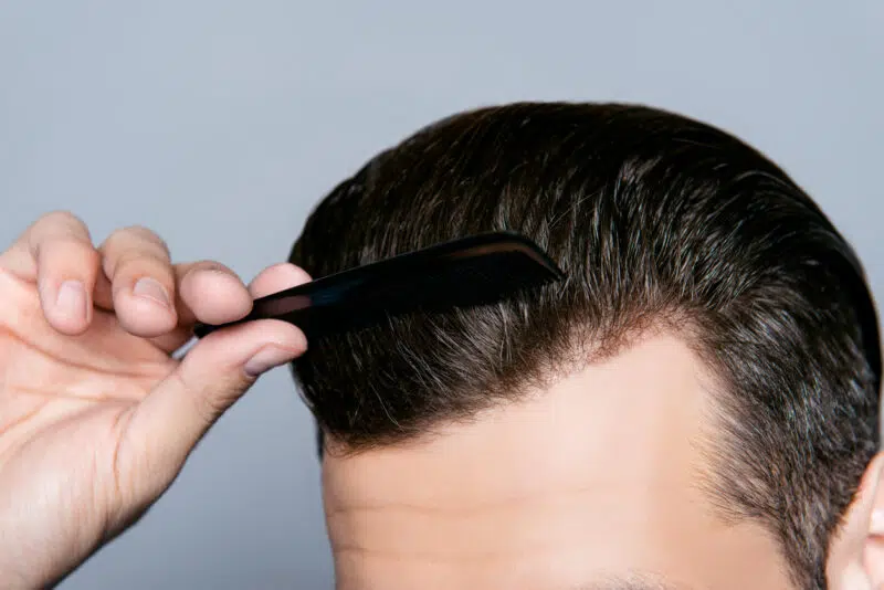 MicroNeedling for Hair Growth