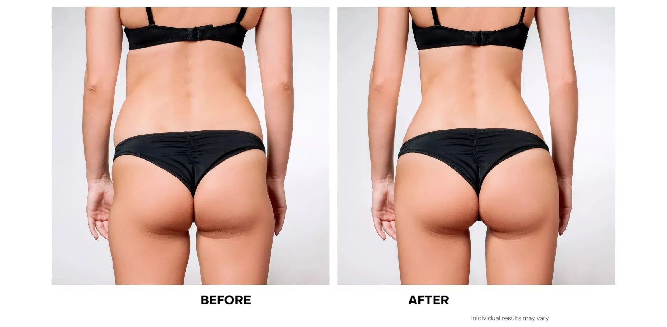 Sculptra Butt Lift Toronto, Non-Surgical BBL Toronto