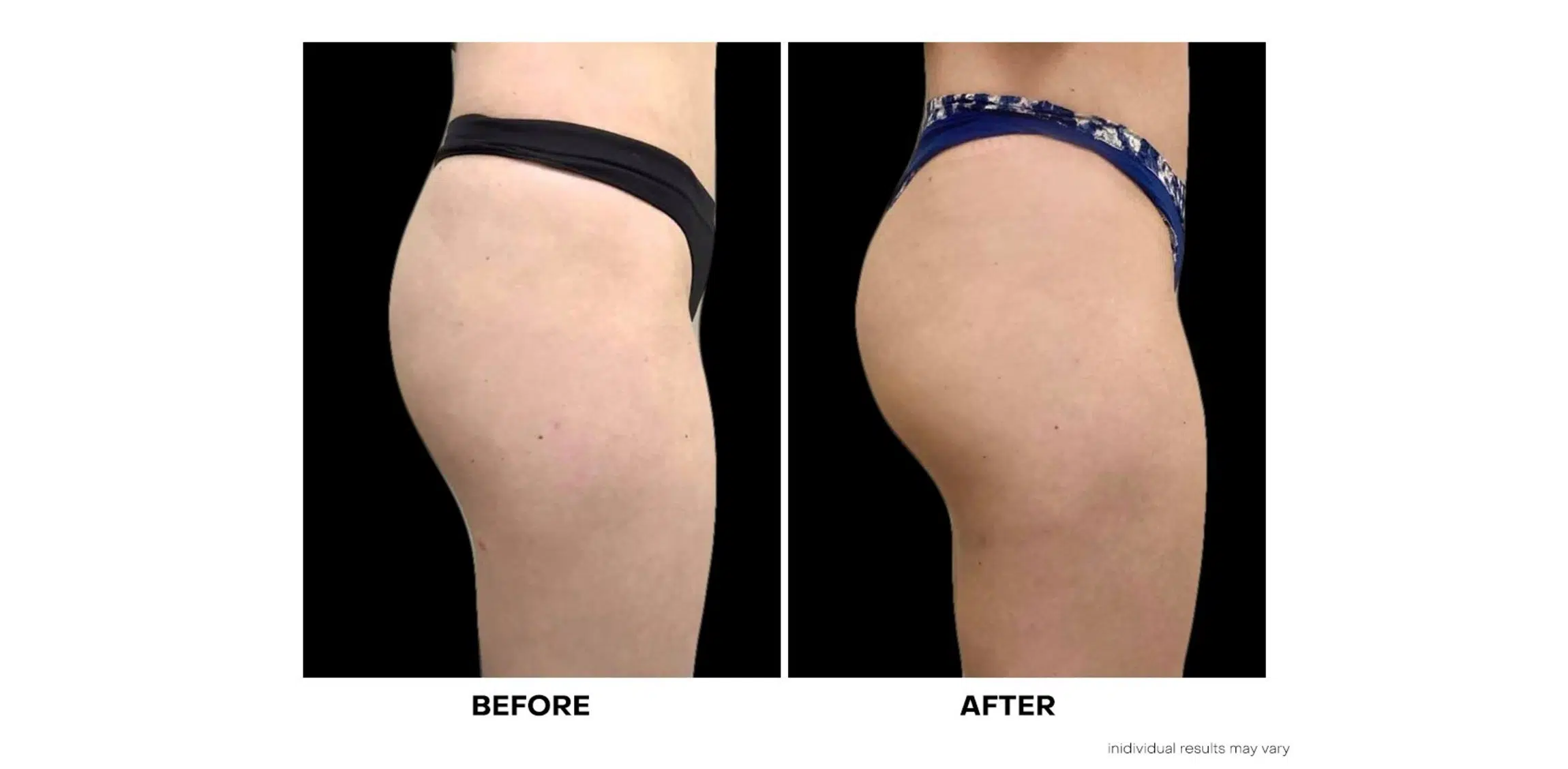 Sculptra® Butt Lift Toronto, Non-Surgical BBL Mississauga