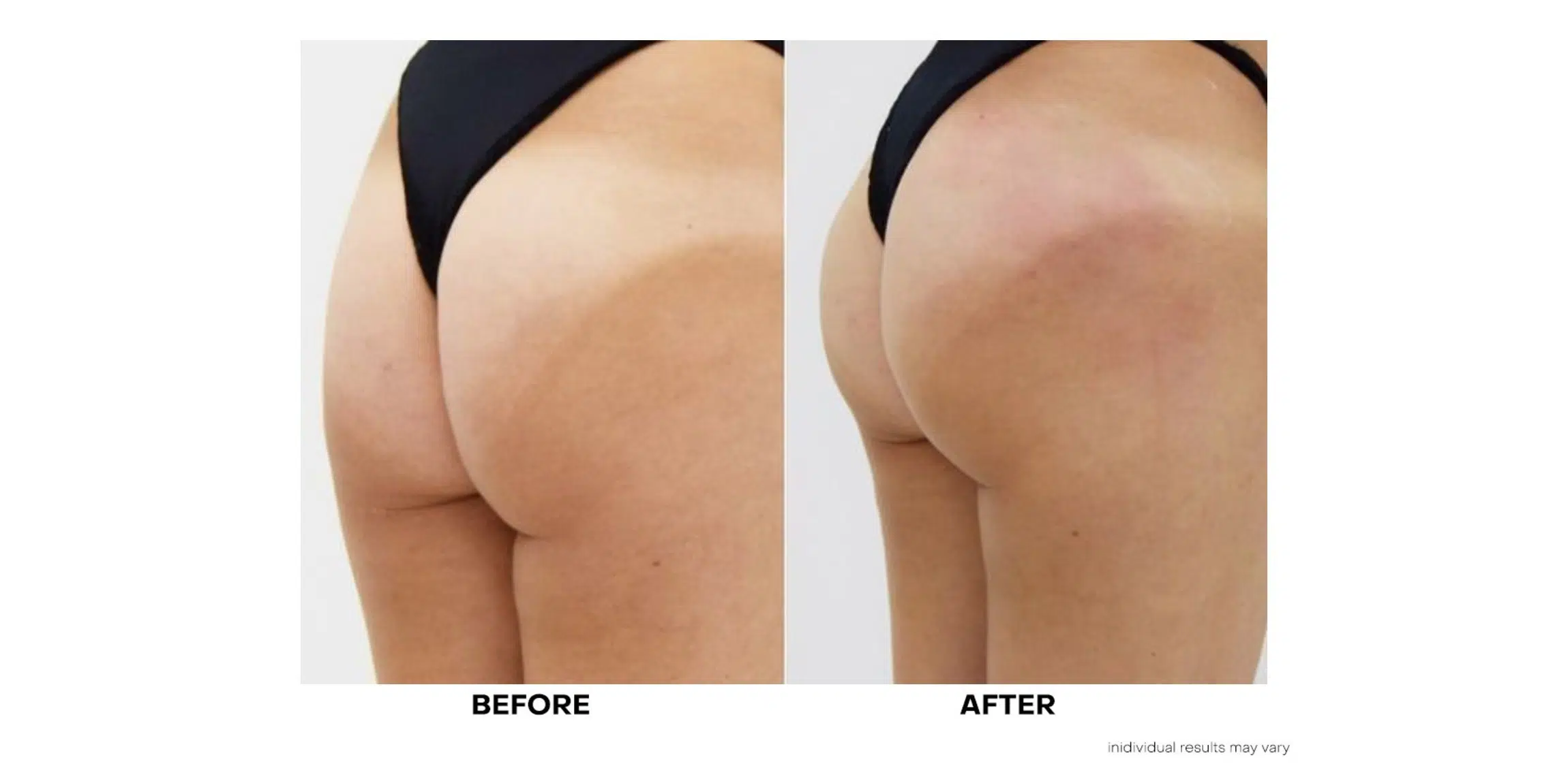 Sculptra Stoney Creek, Non-Surgical Butt Lift Near Me