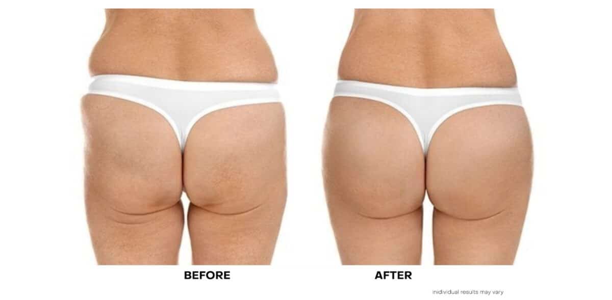 Before and After Sculptra Nonsurgical Butt Lift and Augmentation