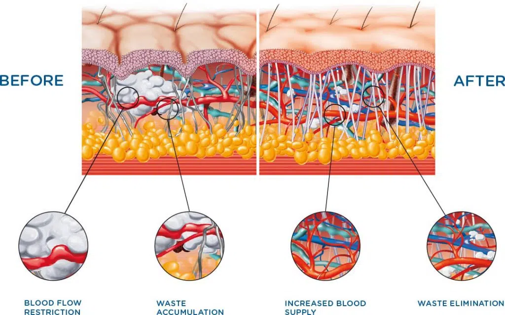 cellulite treatment Toronto