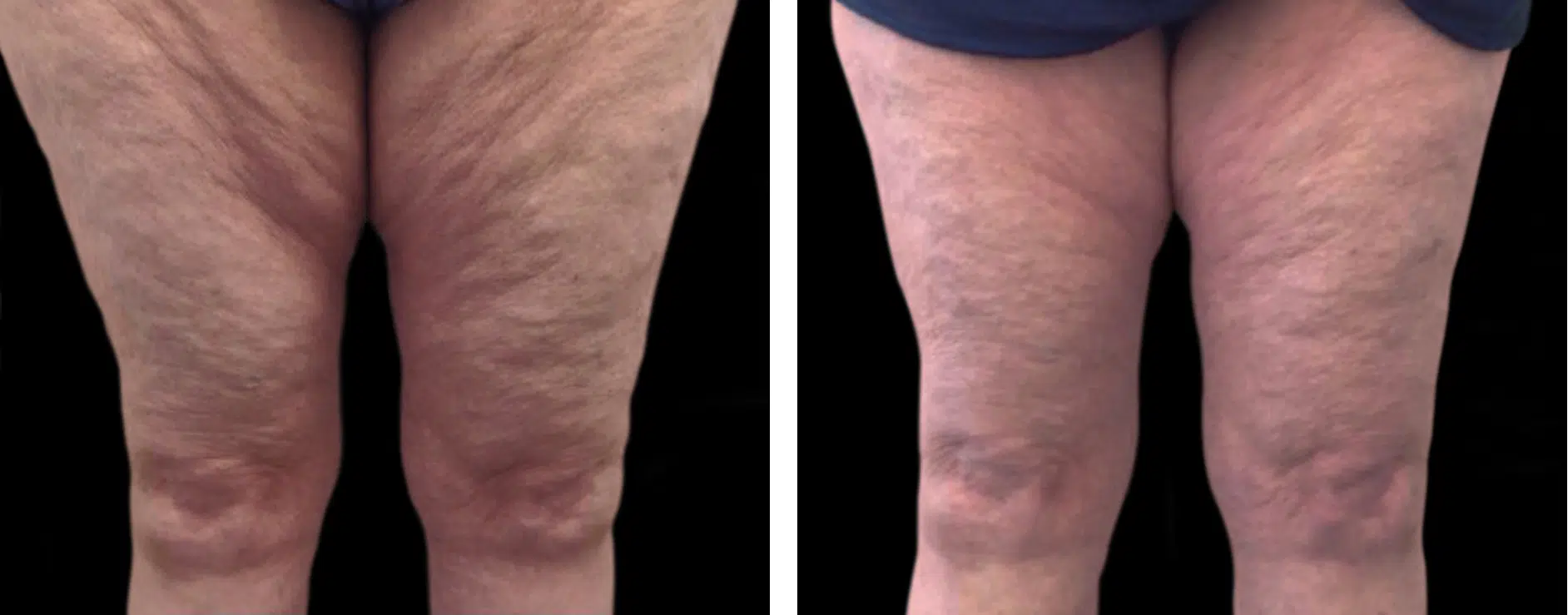 Cellutone Cellulite Removal Treatment Toronto