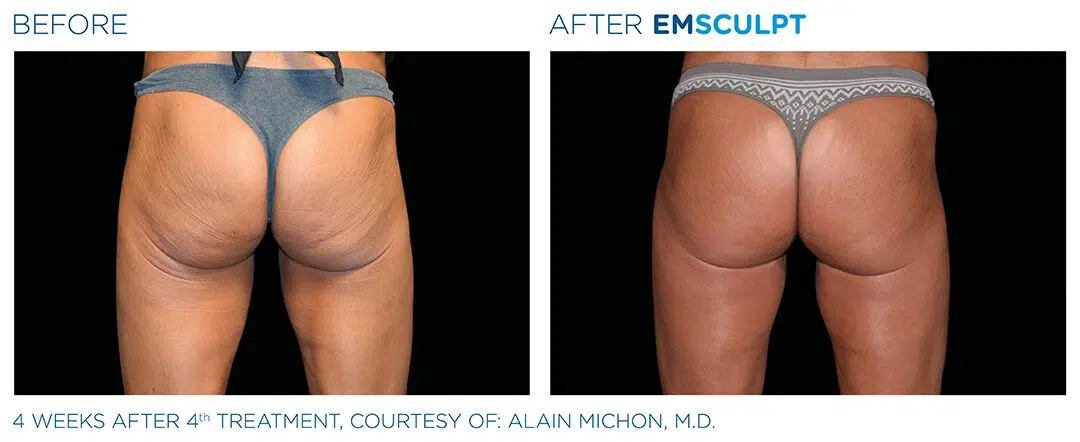 Sculptra BBL Butt Lift Before and After Results