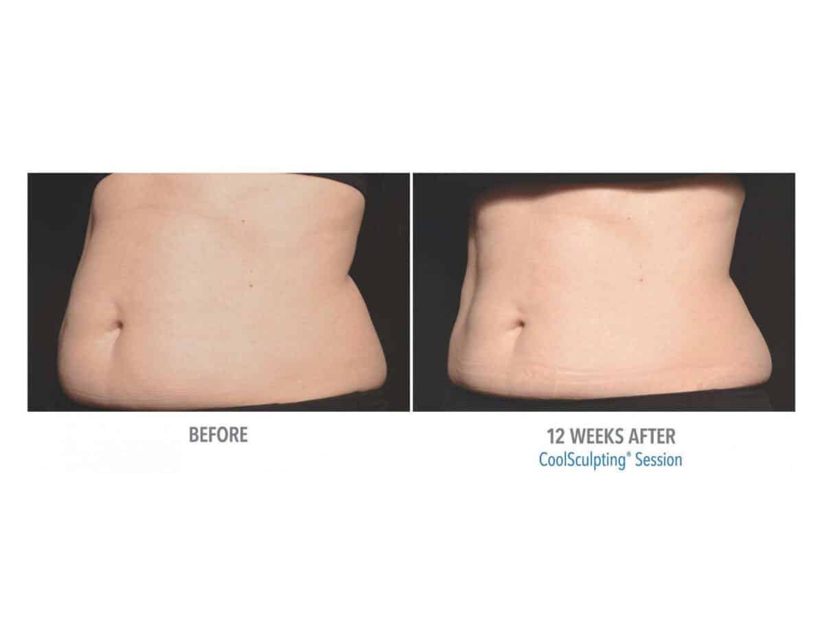 CoolSculpting Stomach Before and After