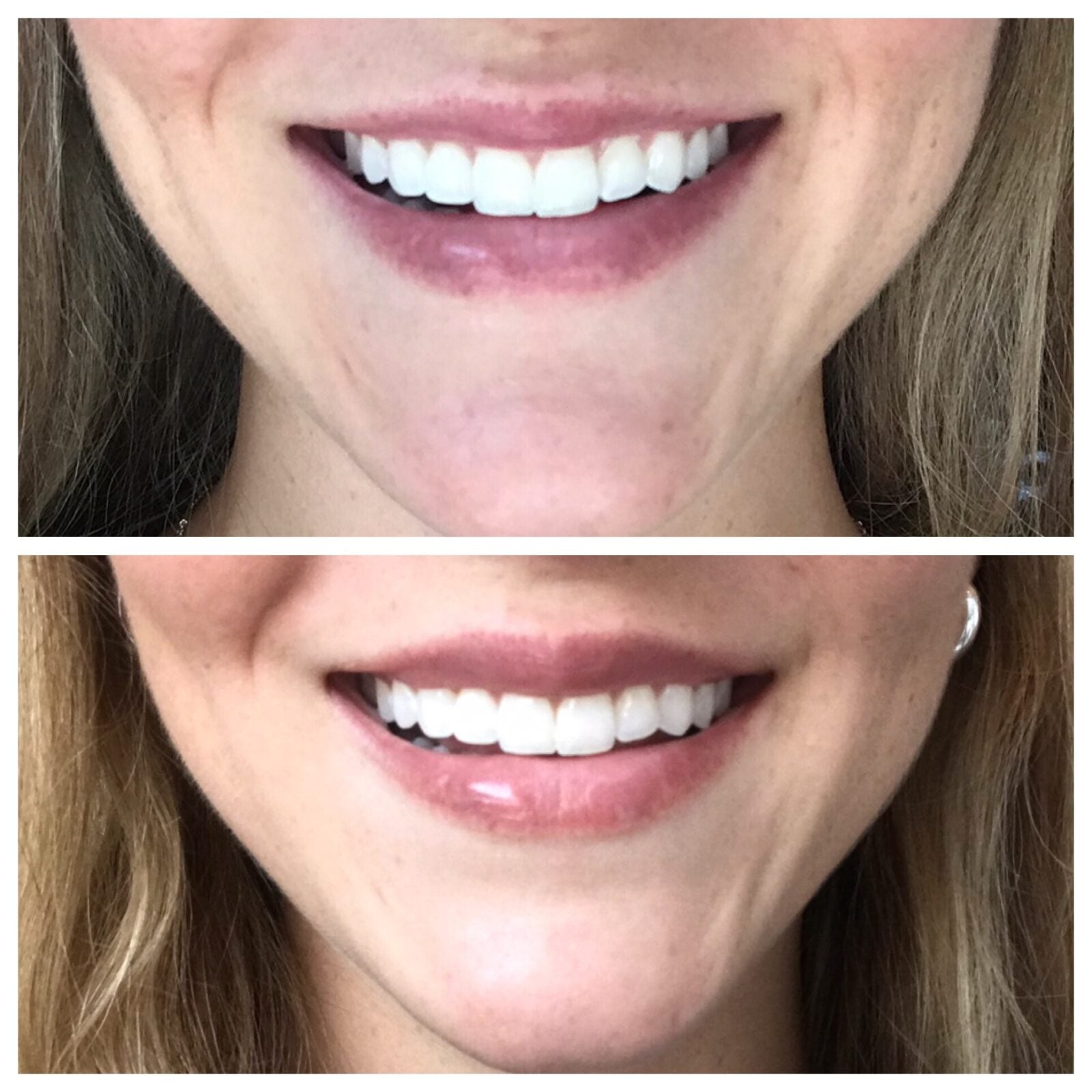 Botox Lip Flip