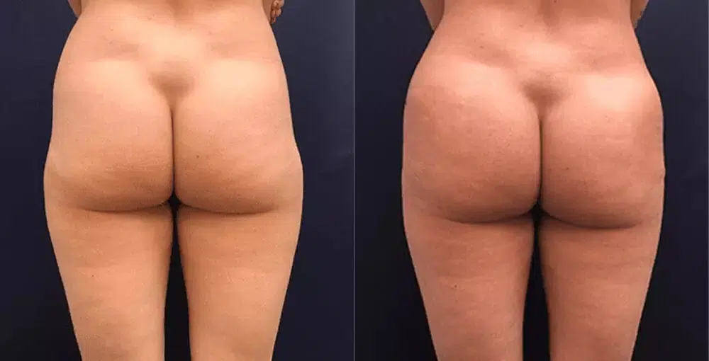 Sculptra Butt Lift Toronto, Non-Surgical BBL Toronto