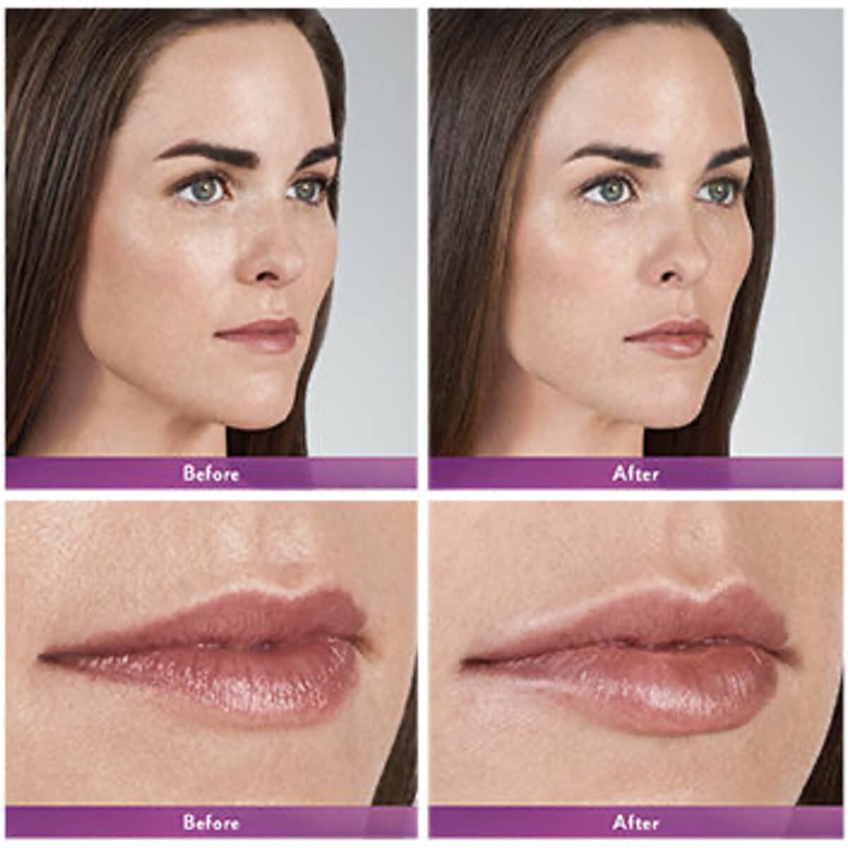 Before-and-After-Lip-Injections