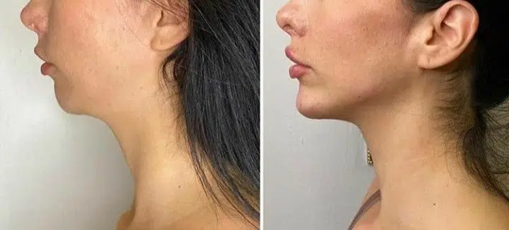 Jawline Filler Before and After