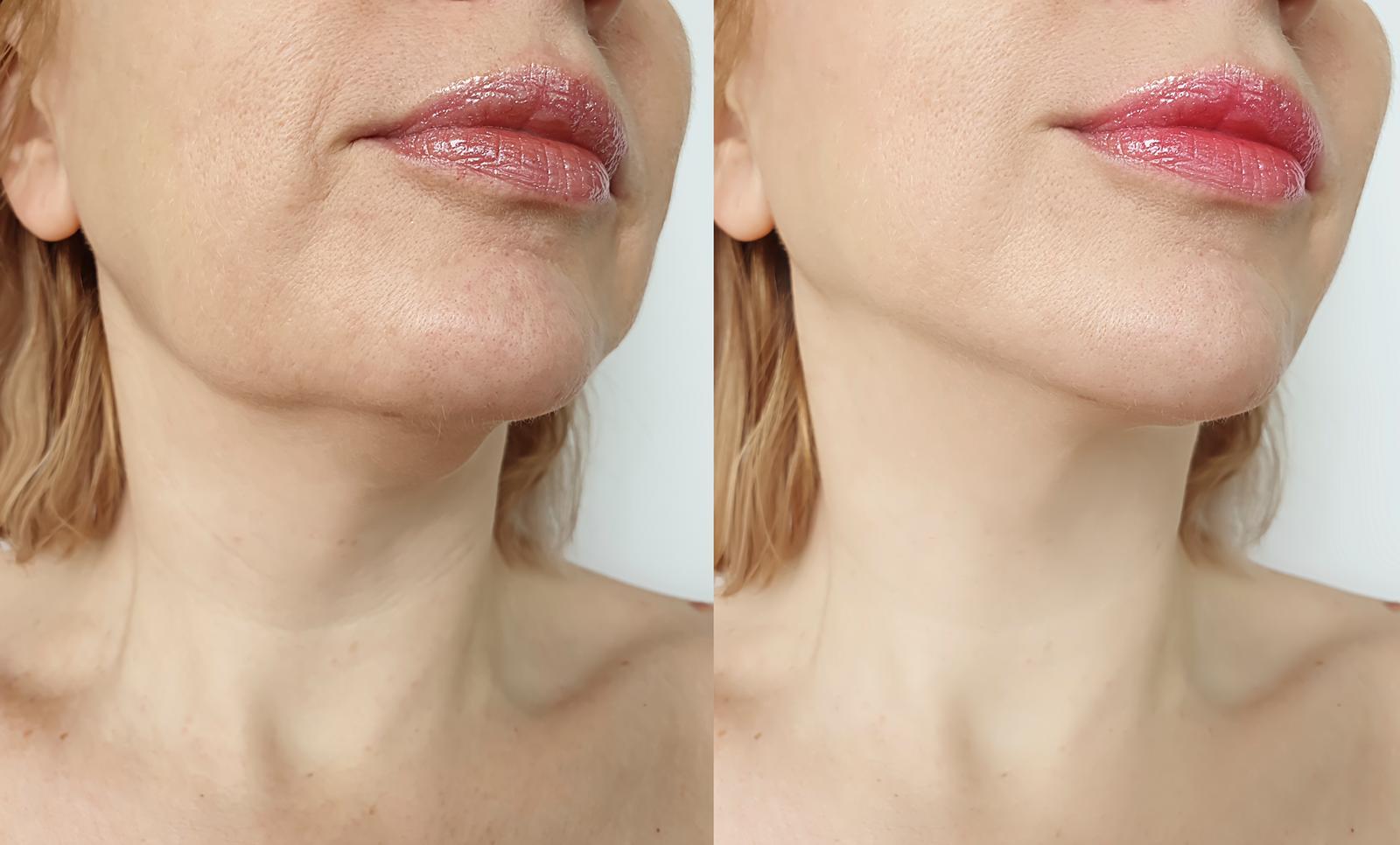 Jawline Filler Toronto Jawline Filler Before After Chin Filler jawline-filler-toronto-jawline-filler-before-after-chin-filler