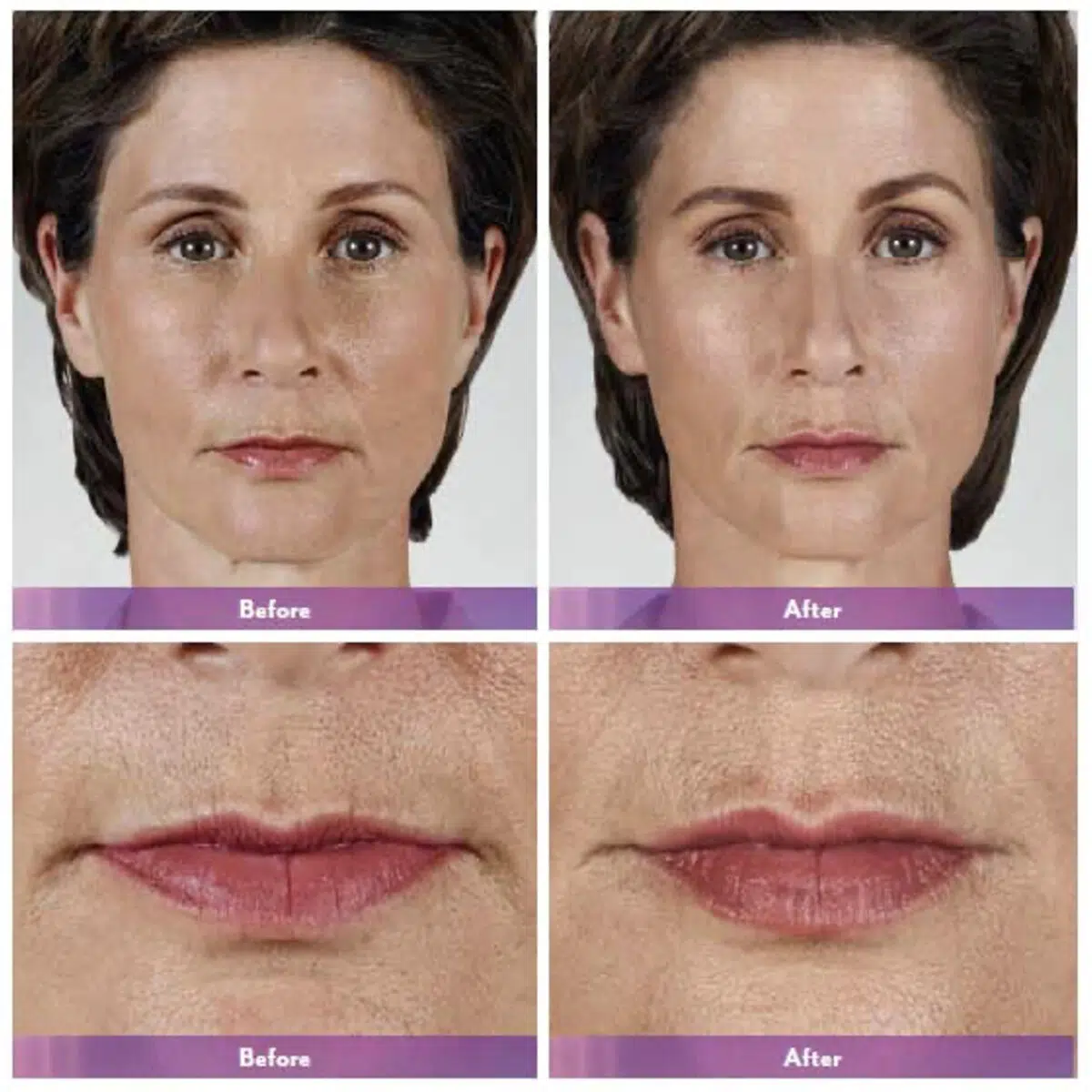 Lip Augmentation