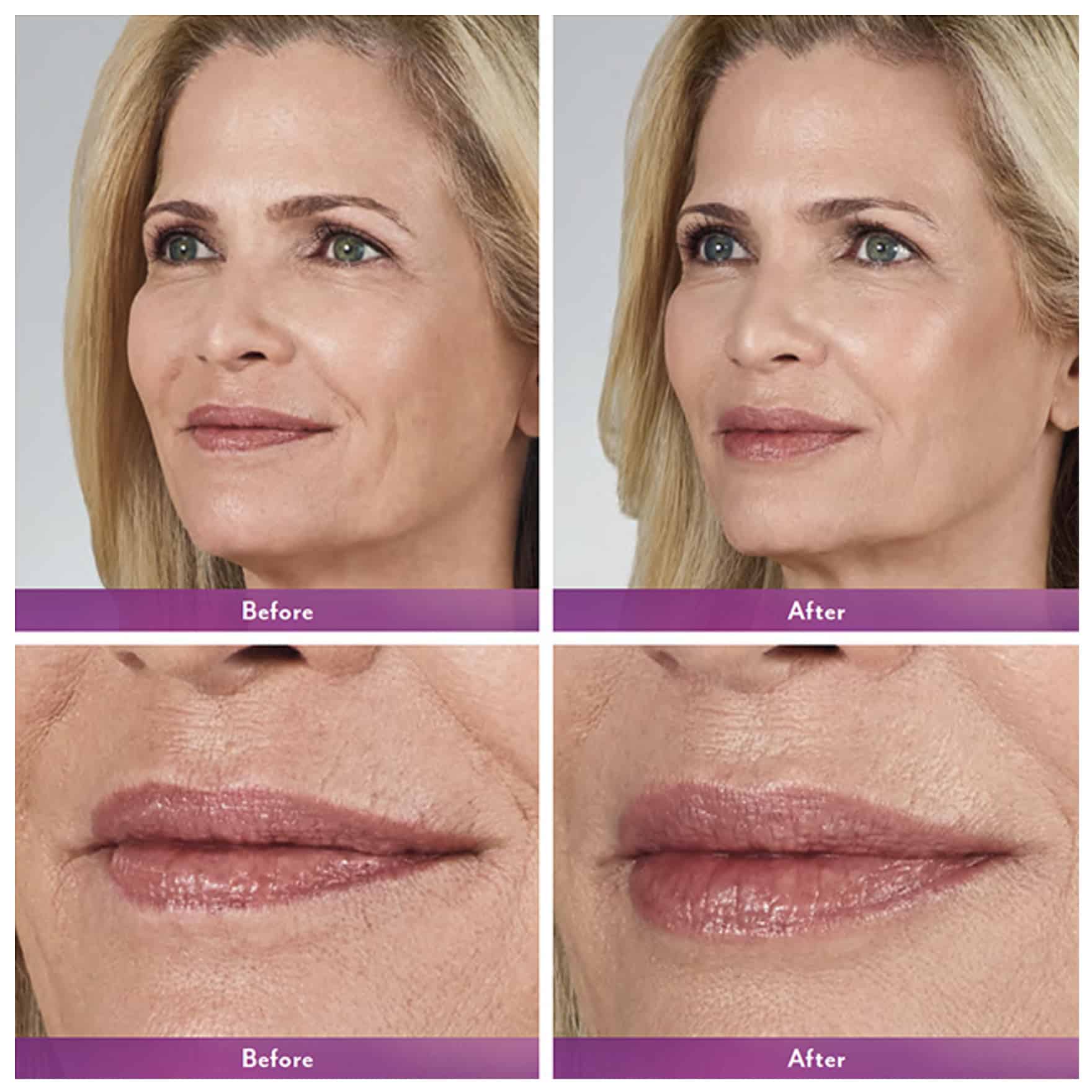 Lip Injections Toronto Botox Lip Flip Toronto Lip Fillers Near Me