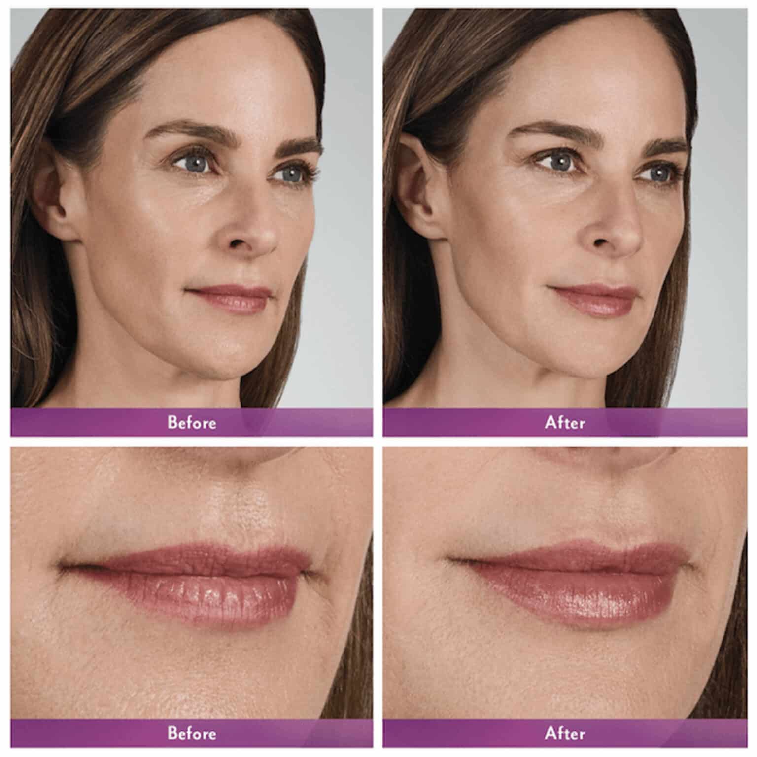 Lip Fillers Toronto Juvederm Fillers Toronto Lip Fillers Near Me