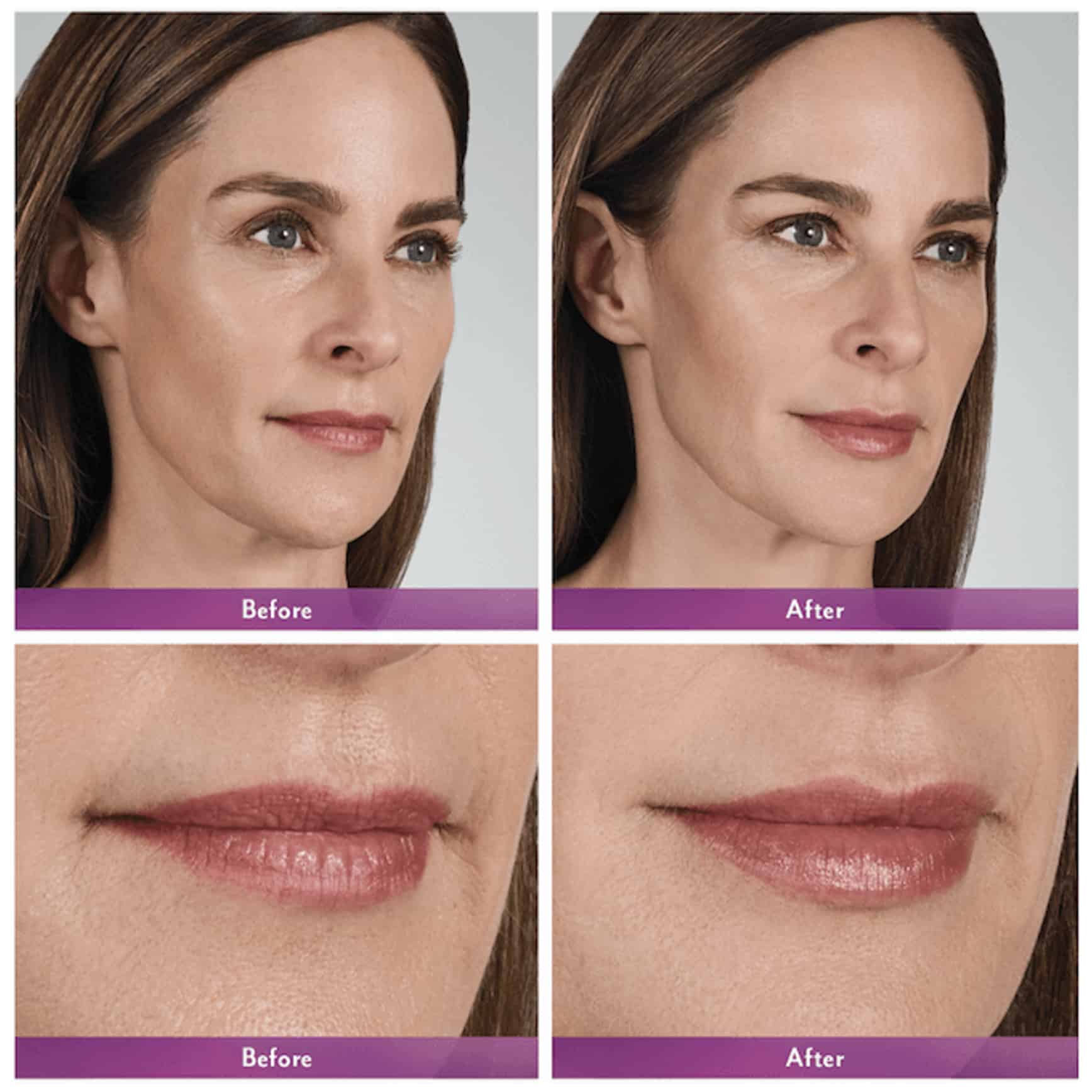 Teosyal vs Juvederm | Difference Teoxane Filler vs Juvederm Filler