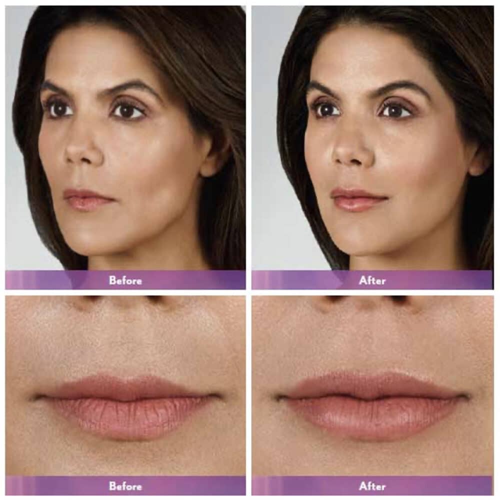 Lip Injections Toronto Botox Lip Flip Toronto Lip Fillers Near Me