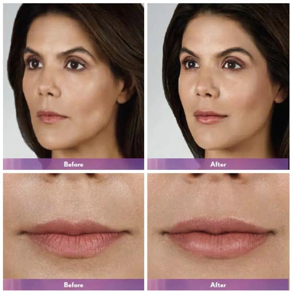 Lip Injections Before and After