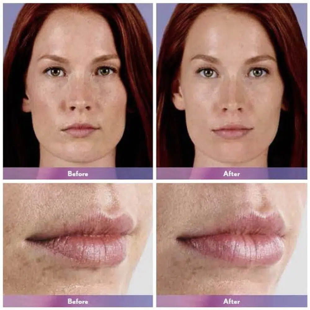 Lip Injections Toronto