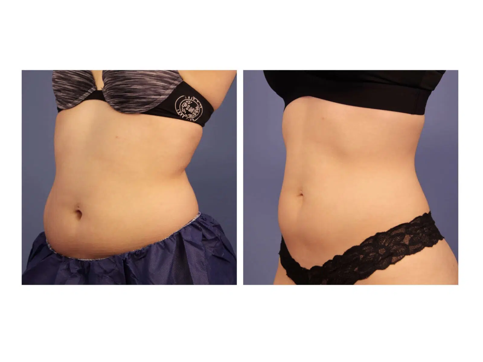 Gaining Weight After A Tummy Tuck – Mississauga Cosmetic Surgery & Laser  Clinic