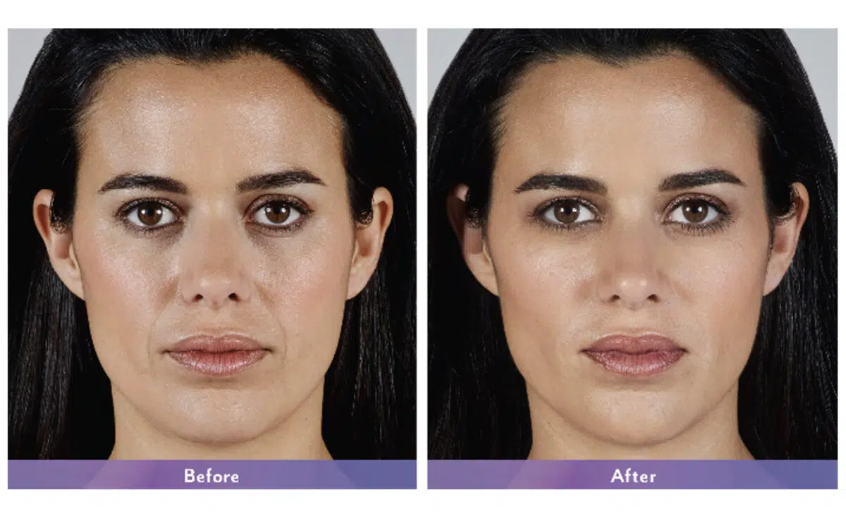 Cheek Filler Before and After