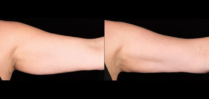 coolsculpting arms results