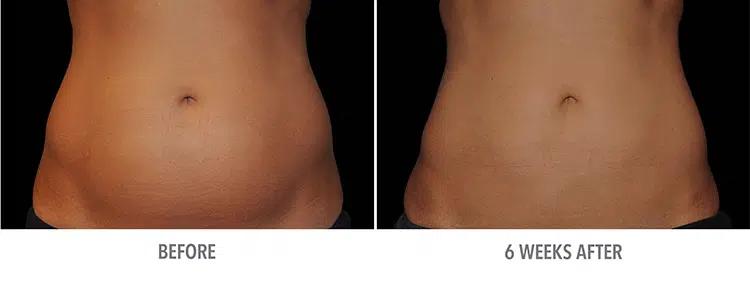 coolsculpting before and after