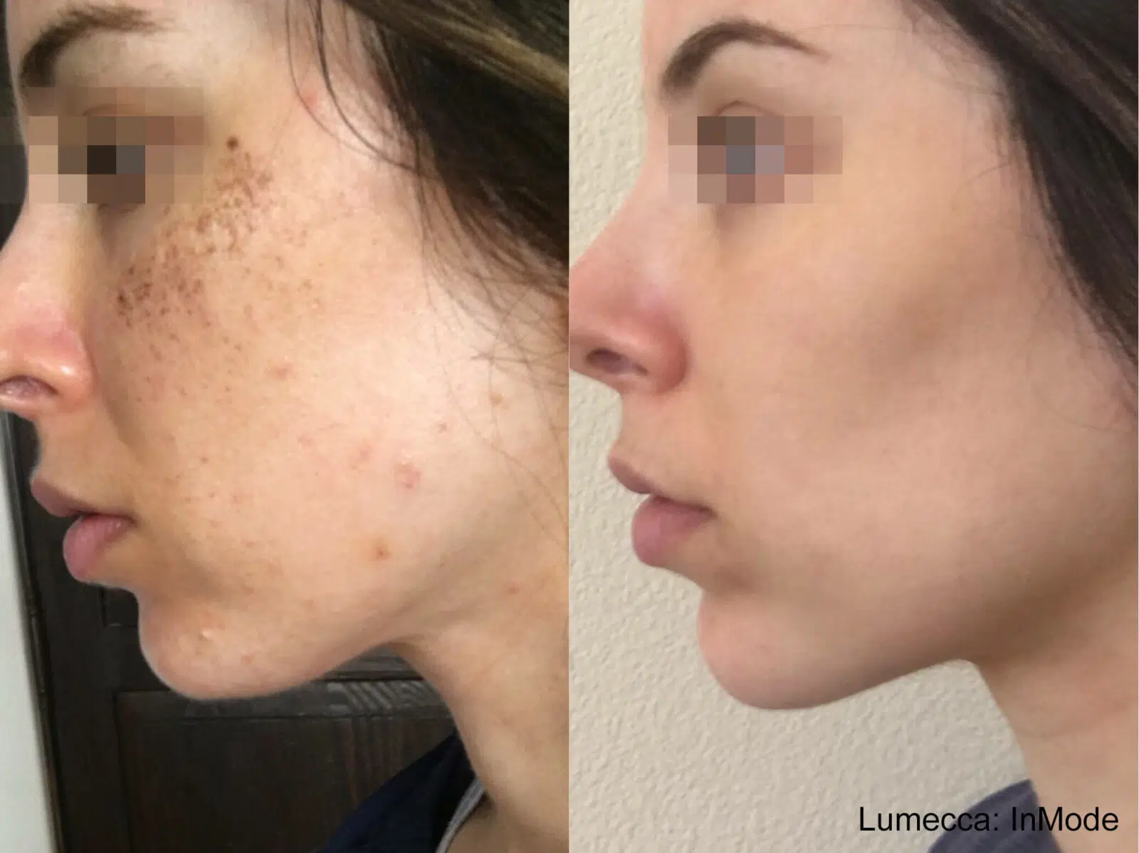Laser Facial for Dark Spots