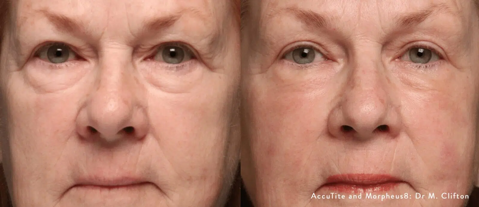 morpheus8 before and after frown lines