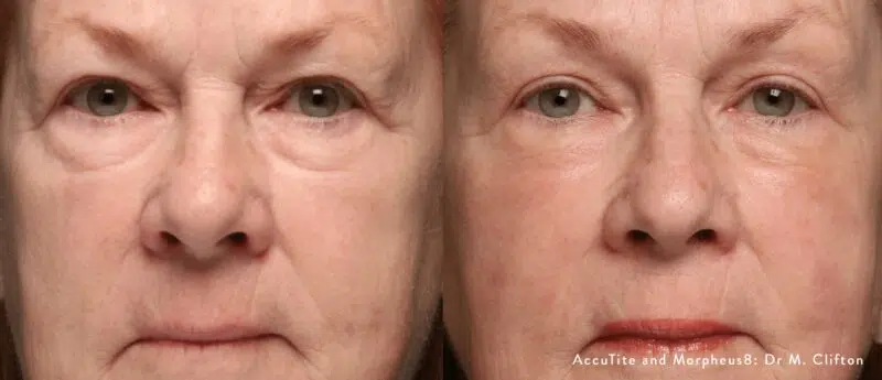 morpheus8 before and after frown lines