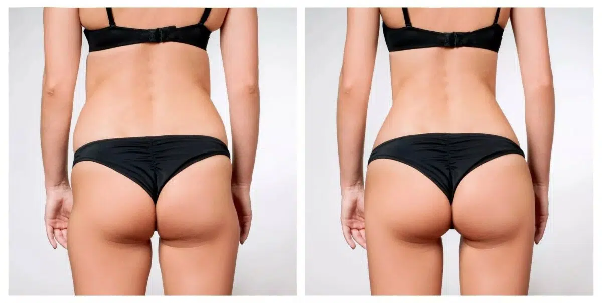 Sculptra BBL butt lift before and after results