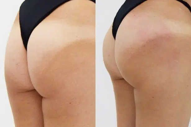 Sculptra BBL butt lift before and after results