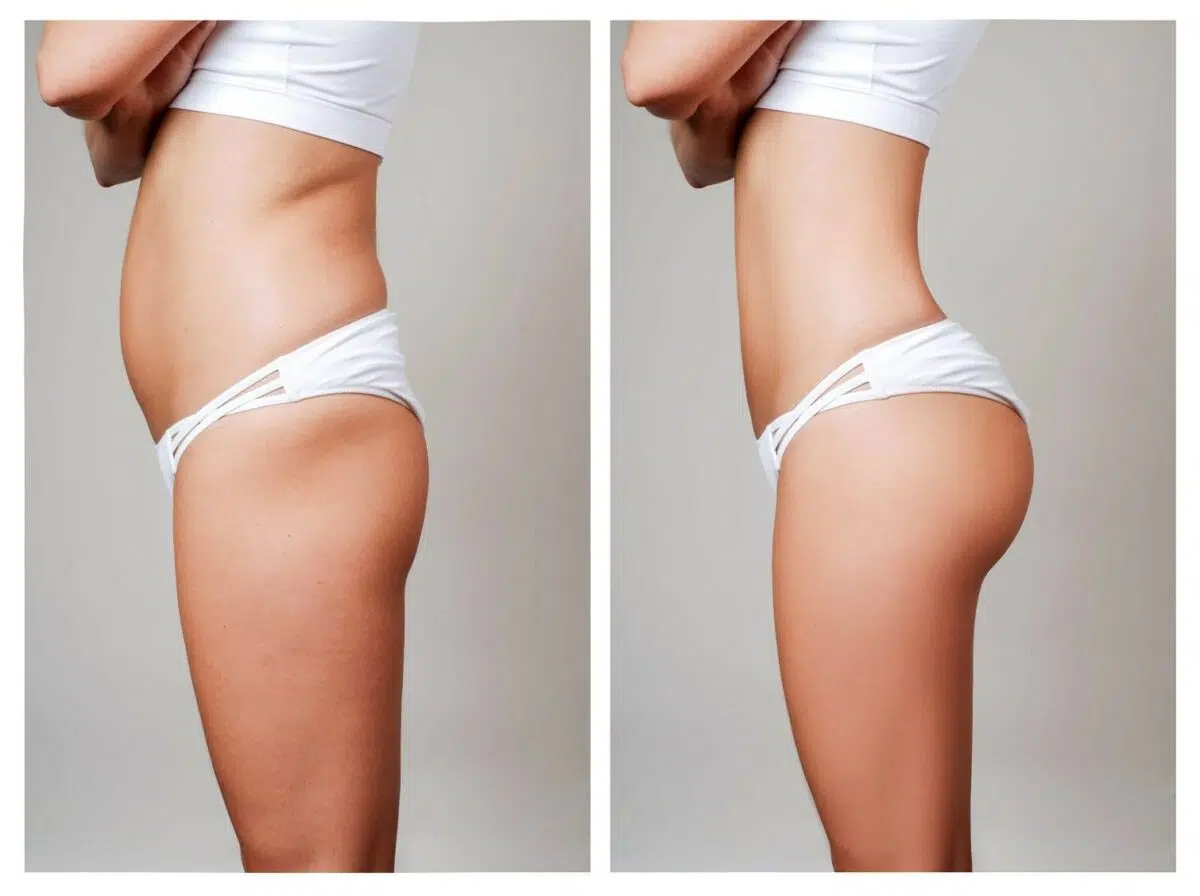 Sculptra BBL before and after