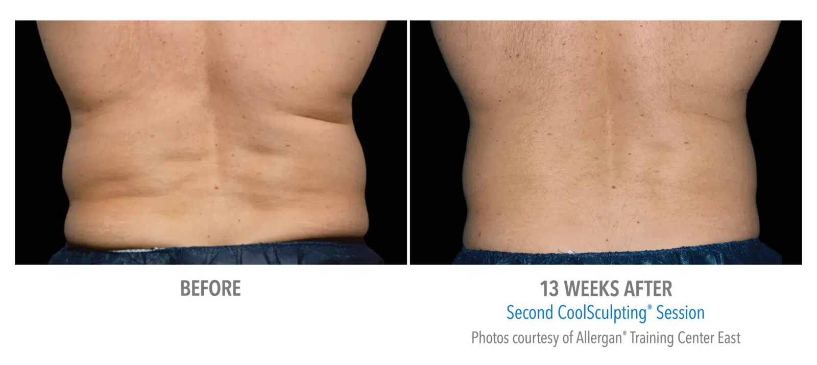 Coolsculpting Whitby - Skin Vitality Medical Clinic Whitby 1614 Dundas St E Unit 101, Whitby, ON L1N 8Y8  1 289-272-2424