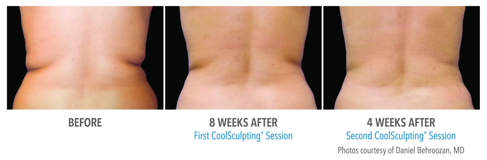 CoolSculpting Whitby before and after back