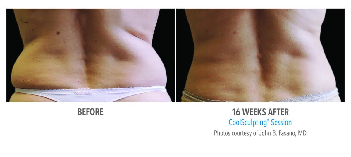 coolsculpting stomach before and after