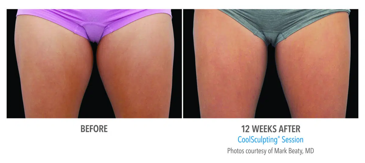 CoolSculpting before and after