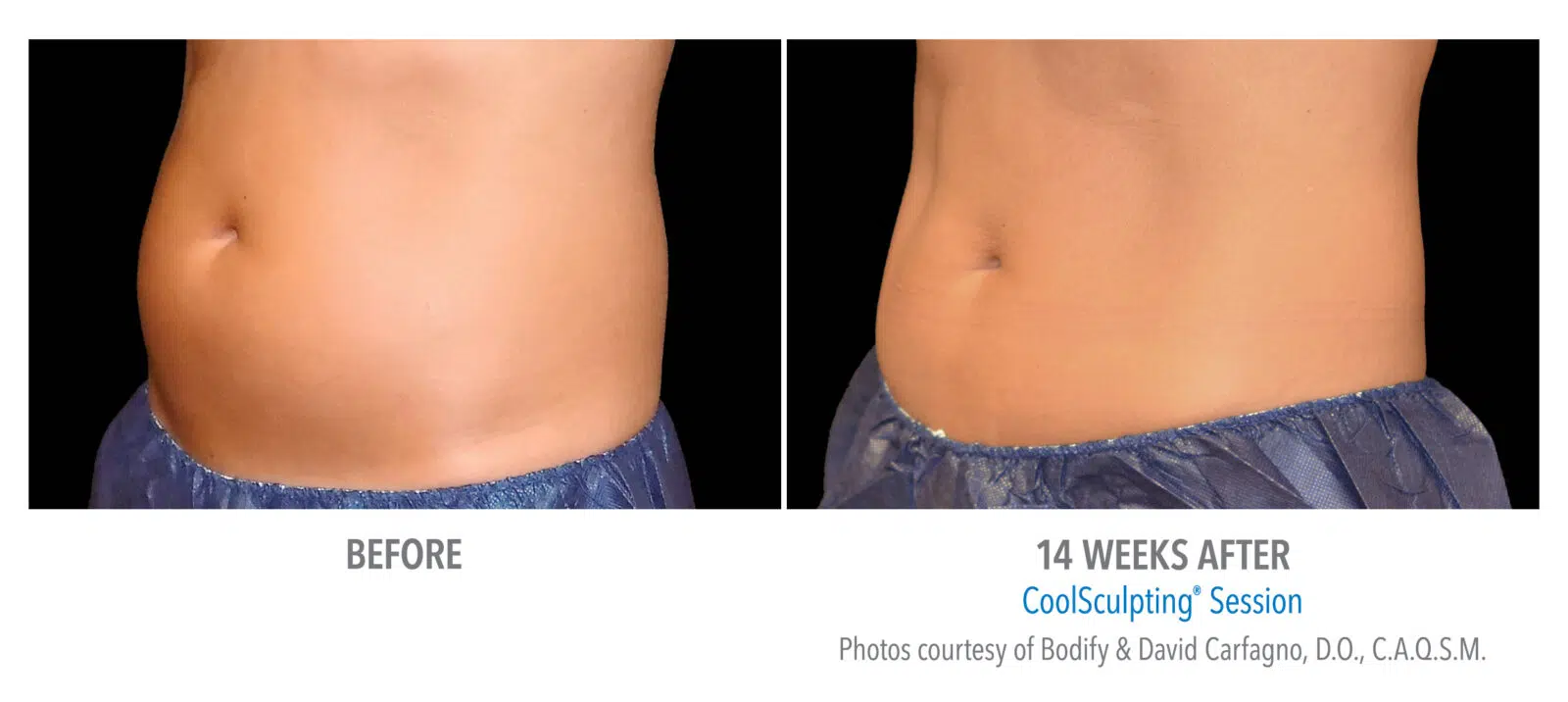 Coolsculpting Whitby - Skin Vitality Medical Clinic Whitby 1614 Dundas St E Unit 101, Whitby, ON L1N 8Y8  1 289-272-2424