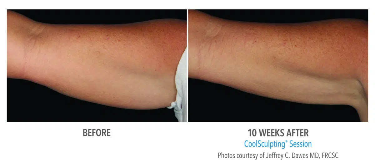 CoolSculpting before and after