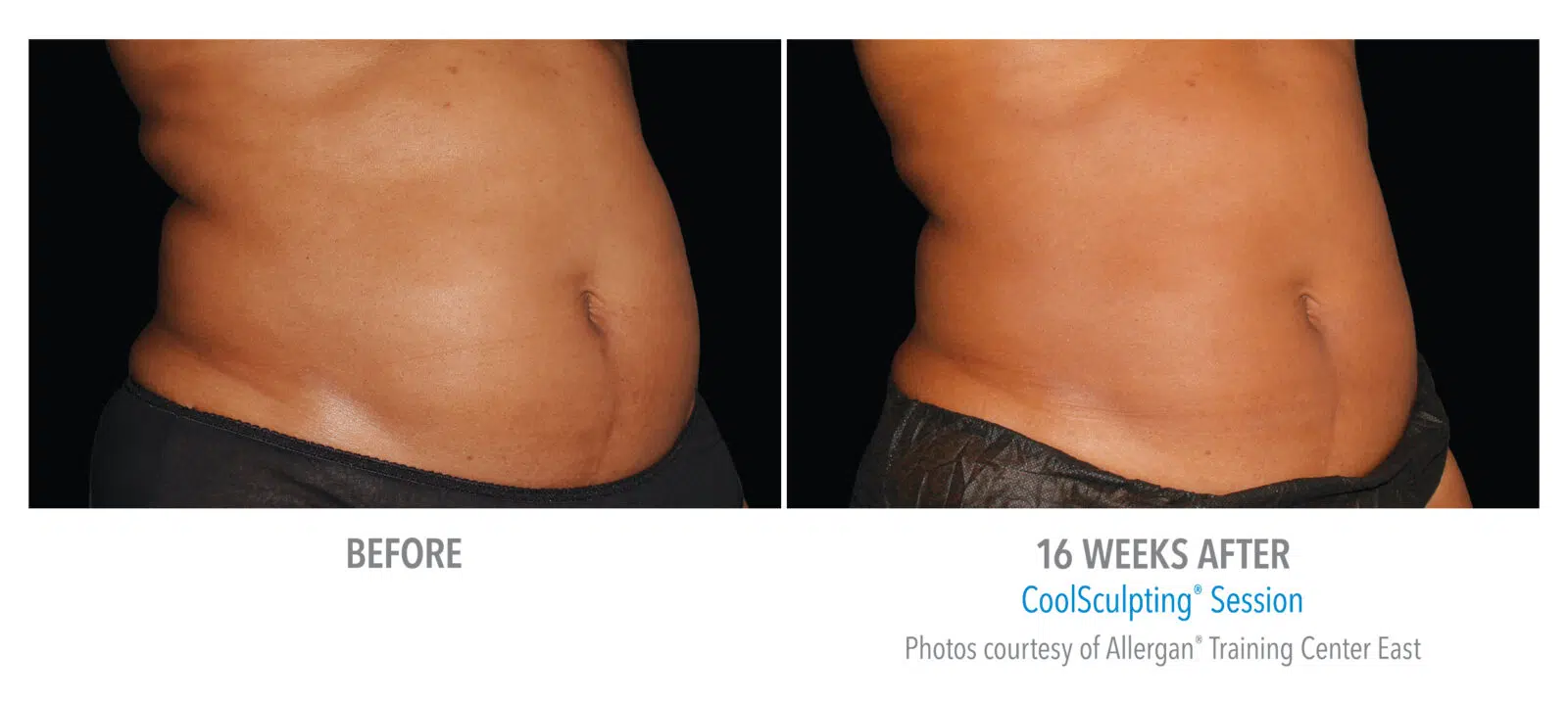 Coolsculpting Whitby - Skin Vitality Medical Clinic Whitby 1614 Dundas St E Unit 101, Whitby, ON L1N 8Y8  1 289-272-2424